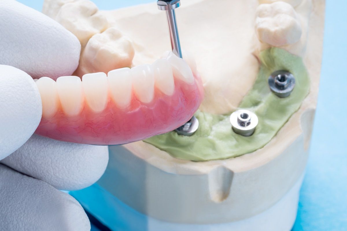 Are You a Candidate for Porcelain Fixed Dental Bridge?