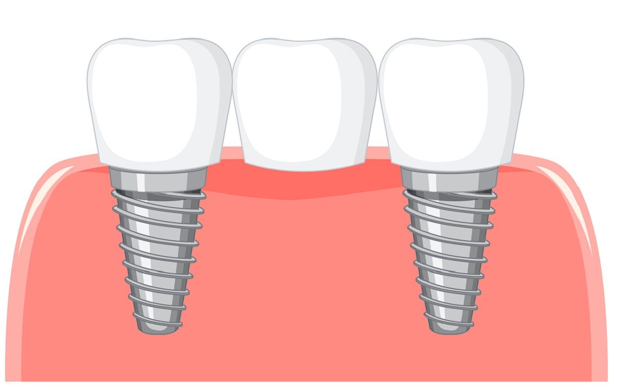 Candidates for Dental Bridges: Who Can Benefit from This Treatment?