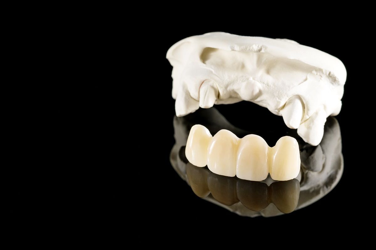 Dental Bridges: Exploring Traditional, Cantilever, and Maryland Options