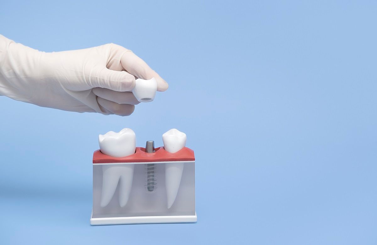 Dental Crowns and Caps: Procedure and Qualifying Criteria