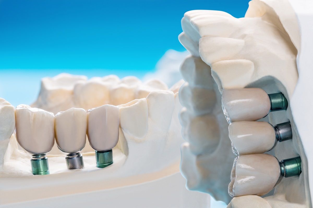 Introduction to Dental Bridges: What Are They and How They Work?