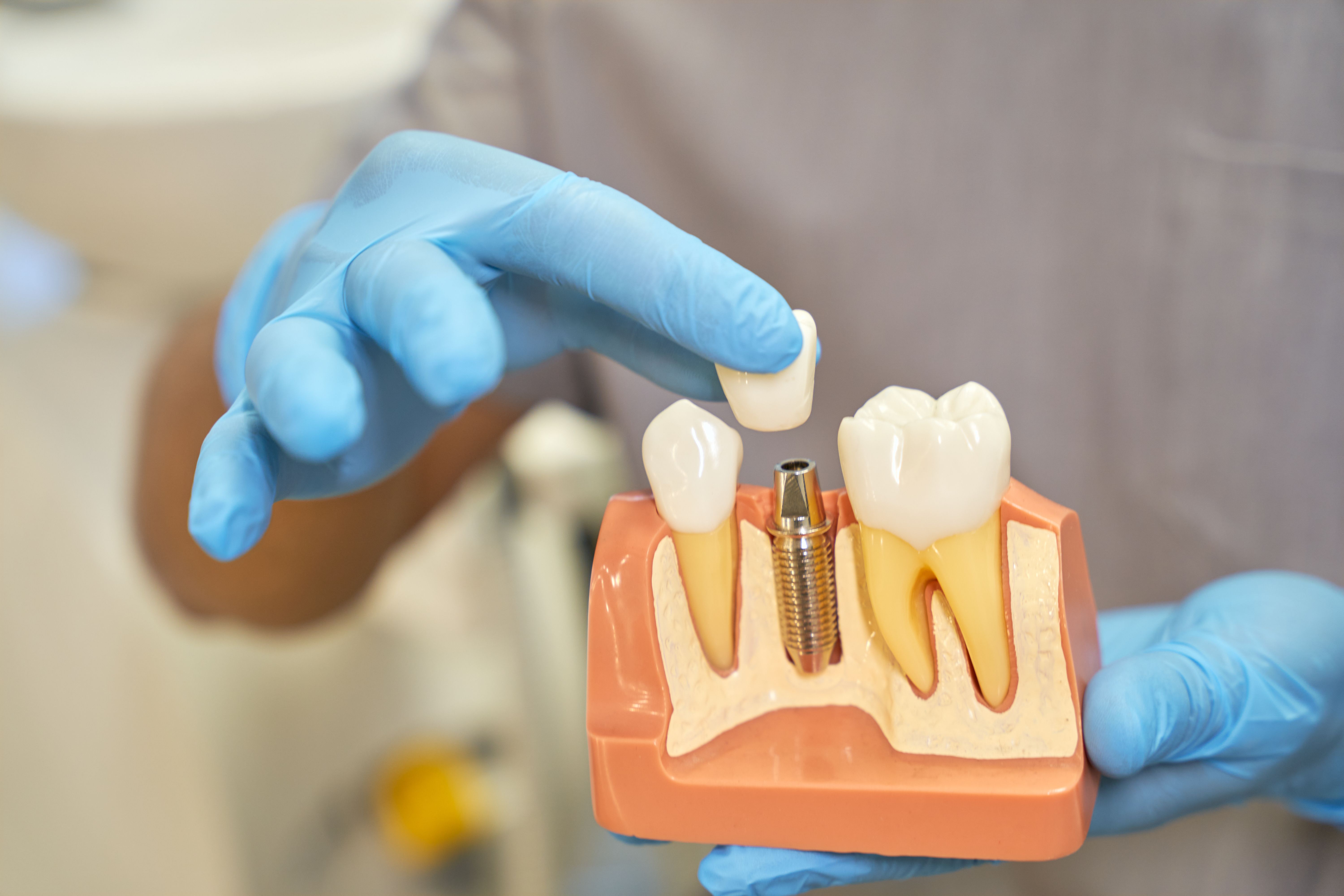 Learn More About Dental Crown Treatment
