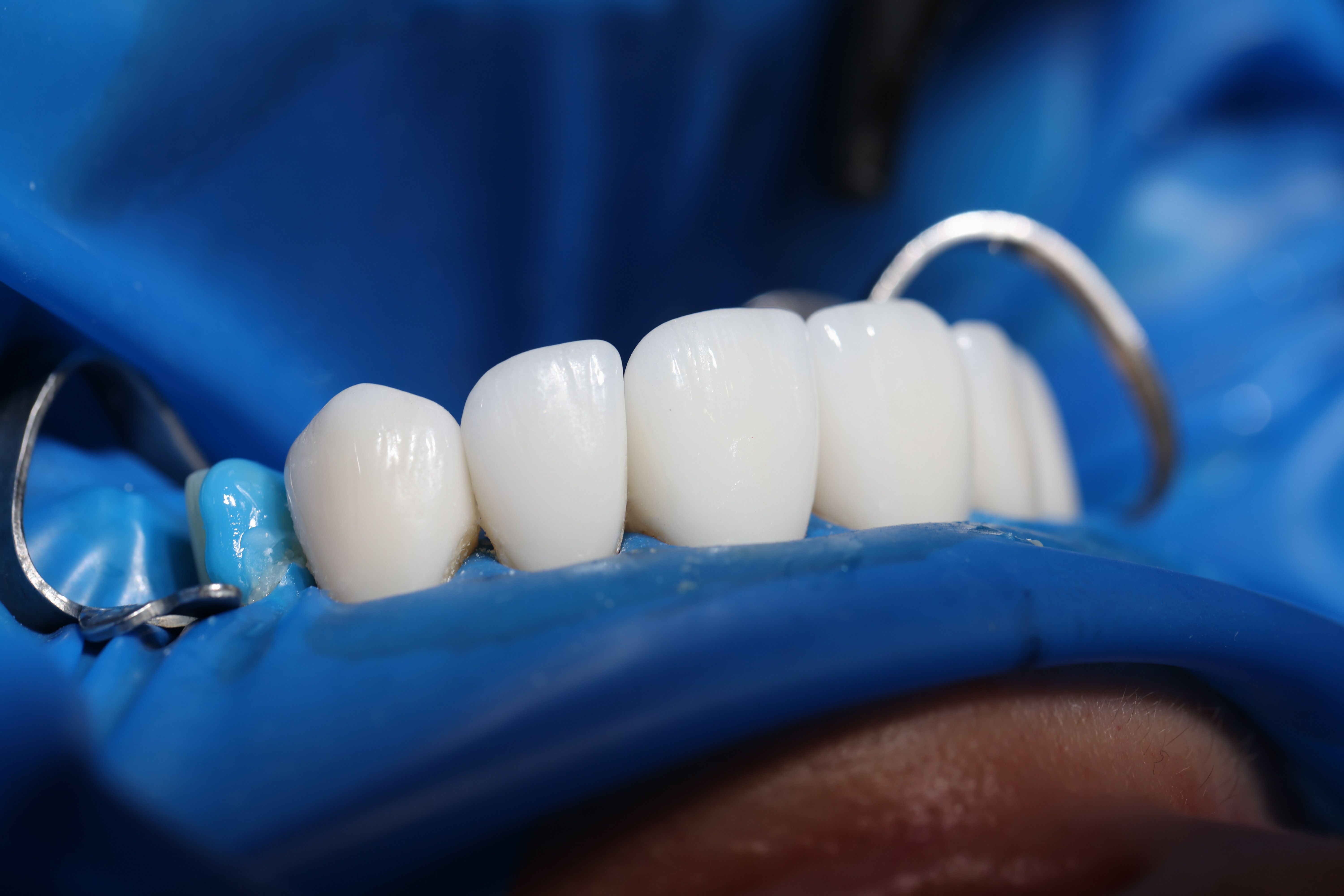 Porcelain Veneers: Who Is a Good Candidate?