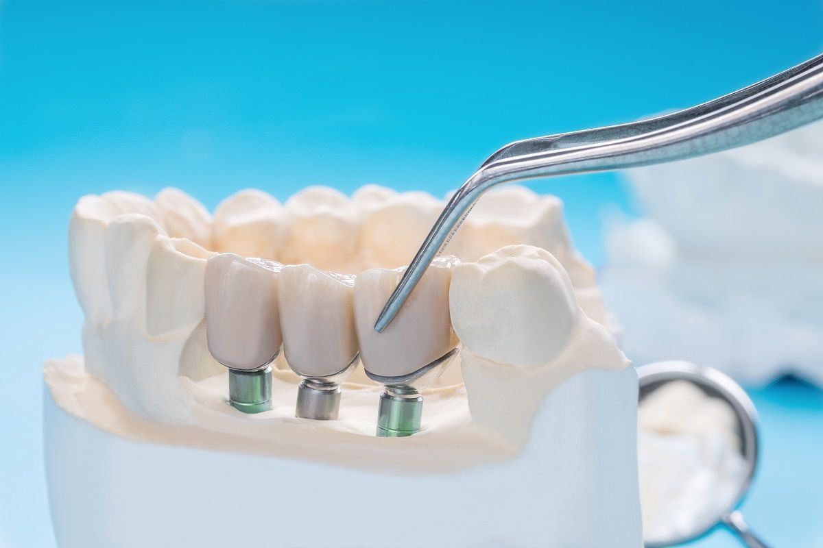 How Long Do Dental Bridges Last? Maintaining Your Restoration