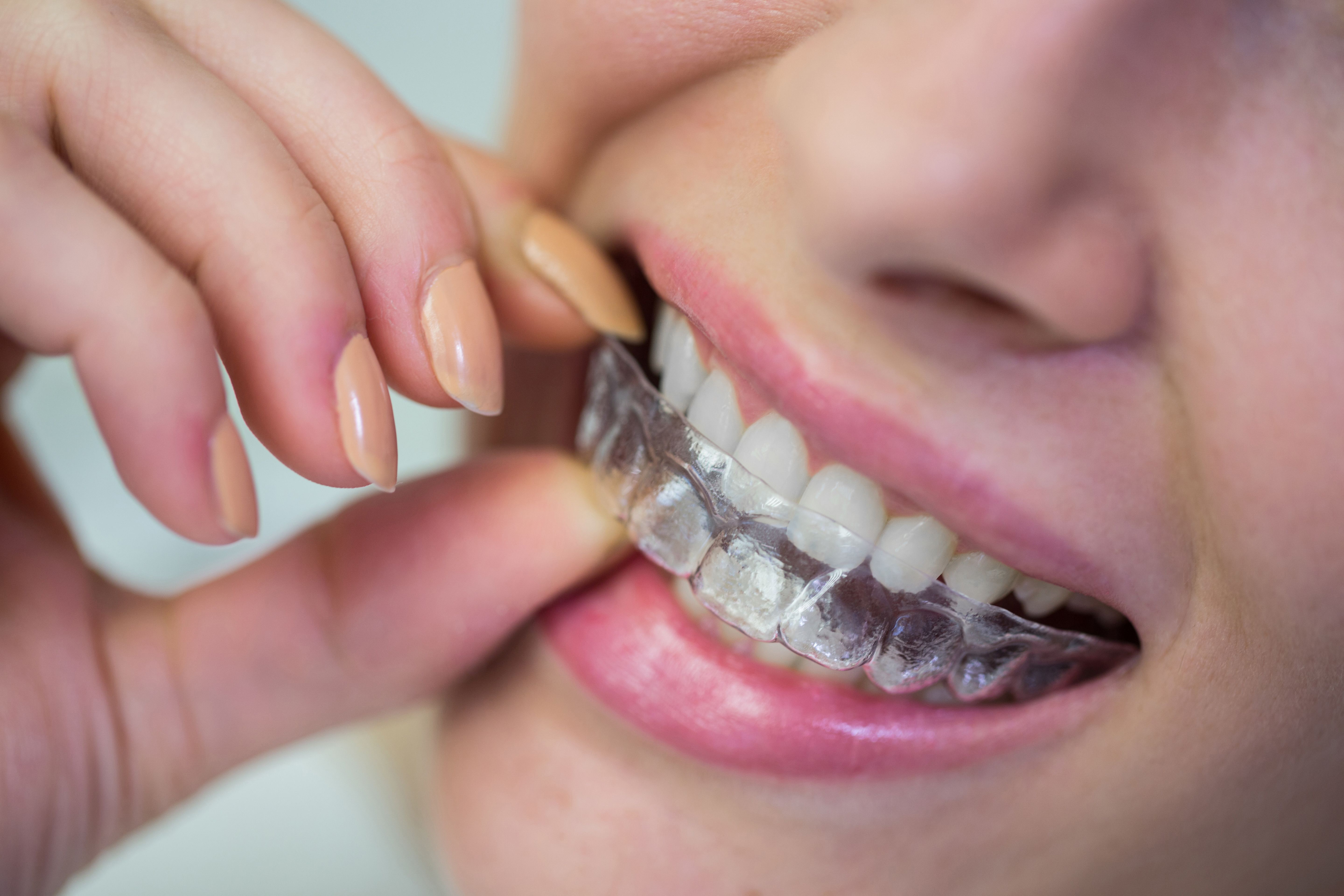 When Should You Consider Getting Invisalign Treatment?