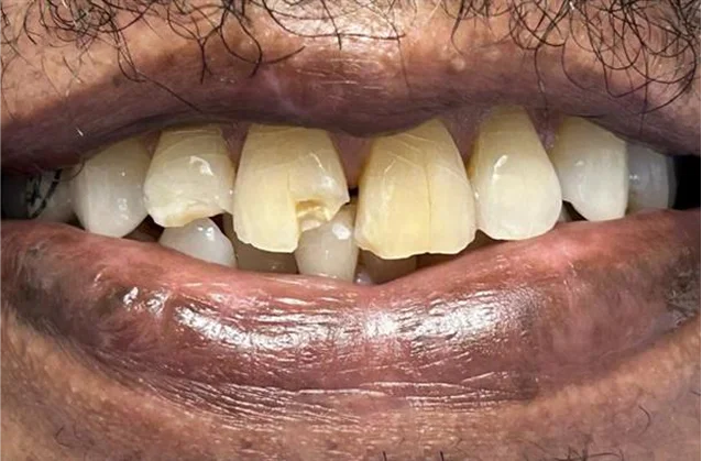 Before: chipped and worn front teeth