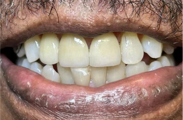 After: restored front teeth