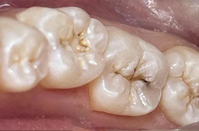 Before: decay on the chewing surfaces of back teeth