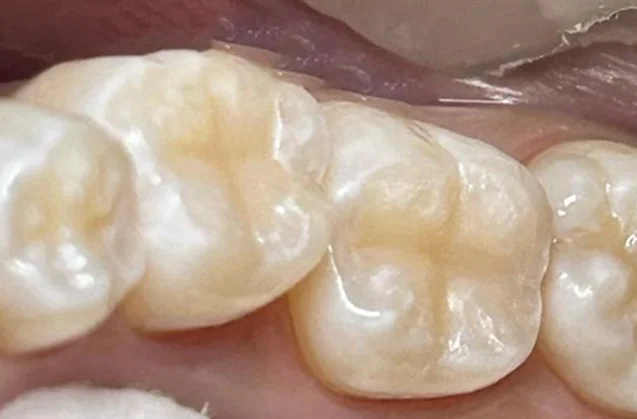 After: restored back teeth