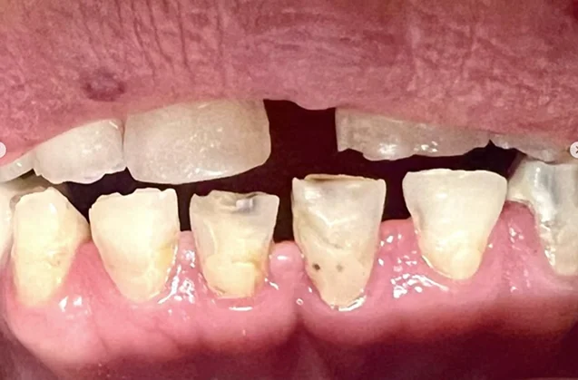 Before: severely worn and broken-down teeth