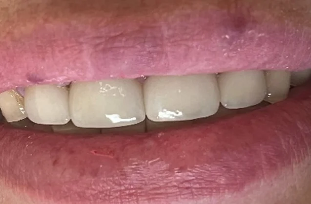 After: restored full smile