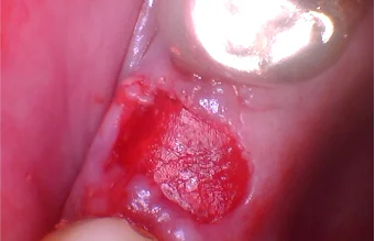 Step 4