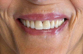 After: restored, even front teeth