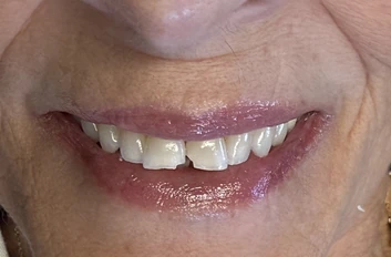 Before: chipped and uneven front teeth
