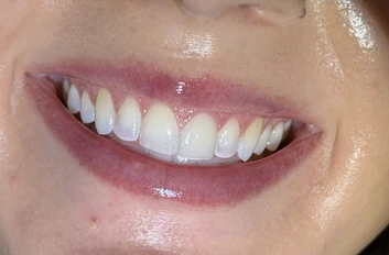 After: evenly colored, bright front teeth