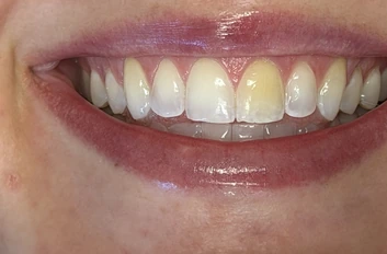 Before: one discolored front tooth