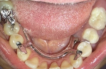 After: lower partial denture replacing missing teeth