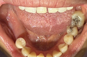 Before: lower jaw with missing teeth