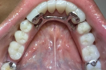 After: upper partial denture replacing missing teeth