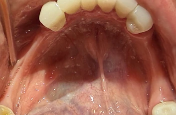 Before: upper jaw with missing teeth